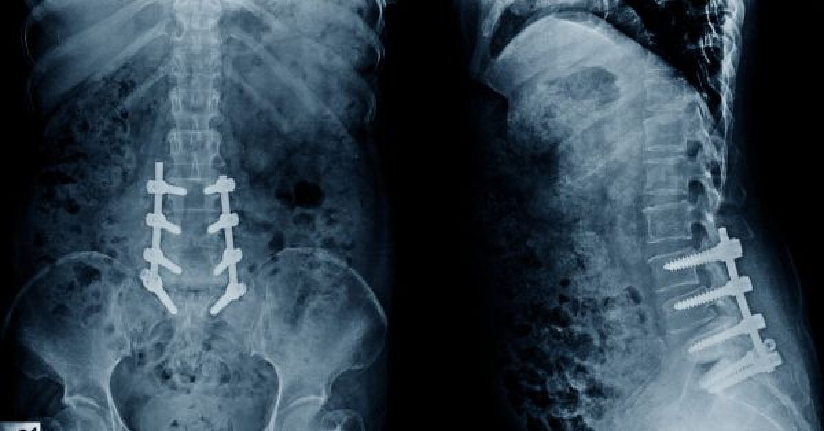 what is degenerative disc disease